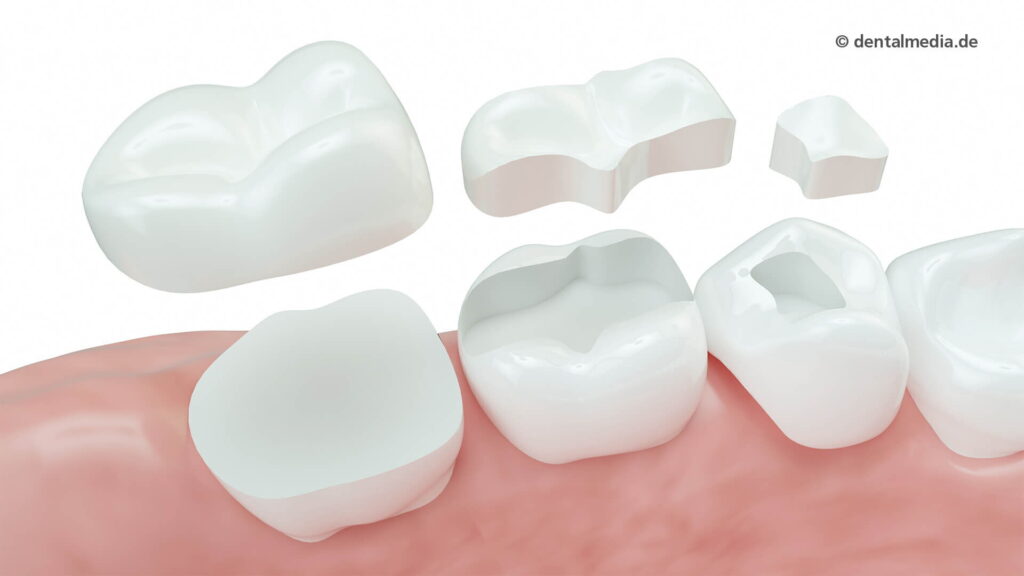Inlays, Onlays, Overlays — DENTOPLUS | Ihre Praxis für Zahnheilkunde in Moers