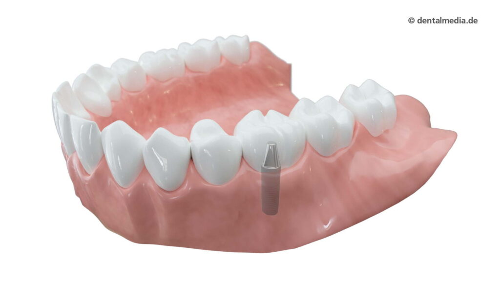Zahnkrone implantatgetragen — DENTOPLUS | Ihre Praxis für Zahnheilkunde in Moers
