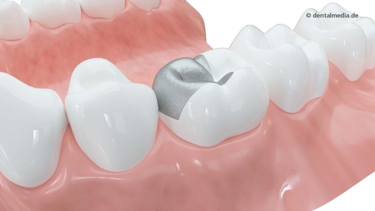 Zahn Amalganfüllung — DENTOPLUS | Ihre Praxis für Zahnheilkunde in Moers