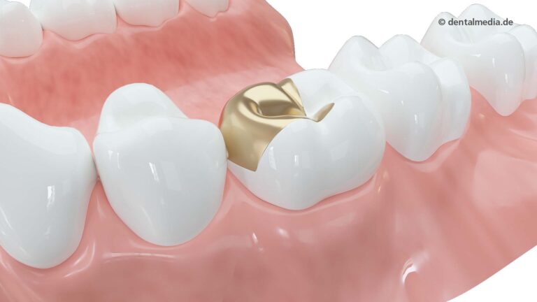 Zahn Goldfüllung — DENTOPLUS | Ihre Praxis für Zahnheilkunde in Moers