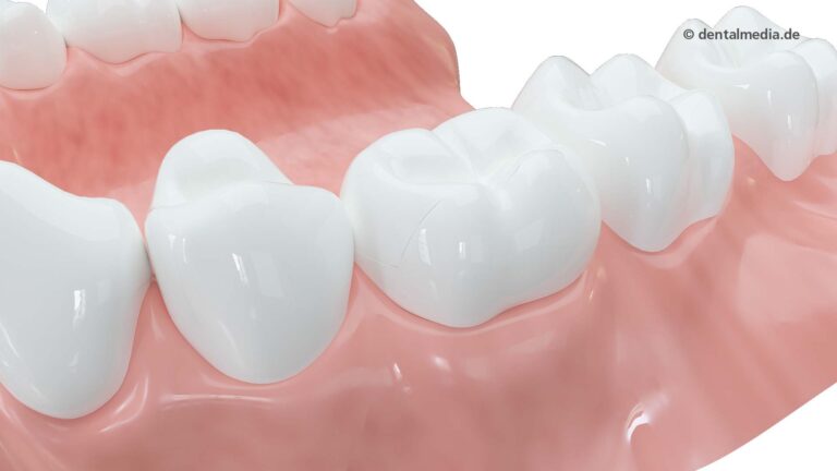Zahn Keramikfüllung — DENTOPLUS | Ihre Praxis für Zahnheilkunde in Moers