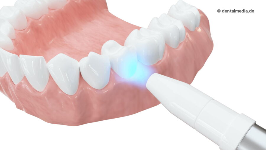 Laserbehandlung Bleaching — DENTOPLUS | Ihre Praxis für Zahnheilkunde in Moers