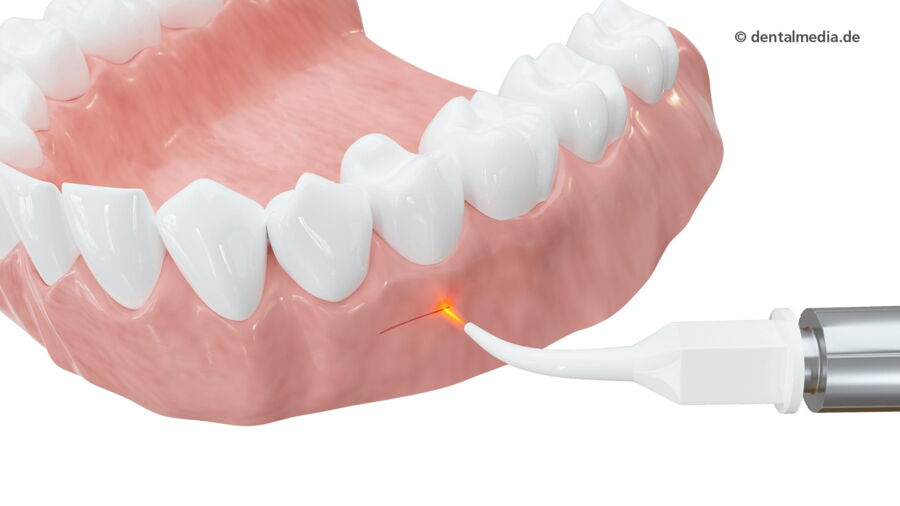 Laserbehandlung — DENTOPLUS | Ihre Praxis für Zahnheilkunde in Moers