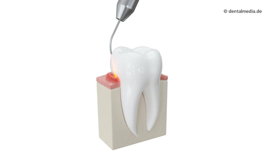 Laserbehandlung Parodontie — DENTOPLUS | Ihre Praxis für Zahnheilkunde in Moers