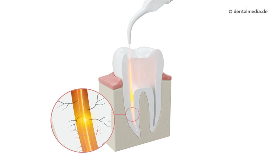 Laser Wurzelbehandlung — DENTOPLUS | Ihre Praxis für Zahnheilkunde in Moers