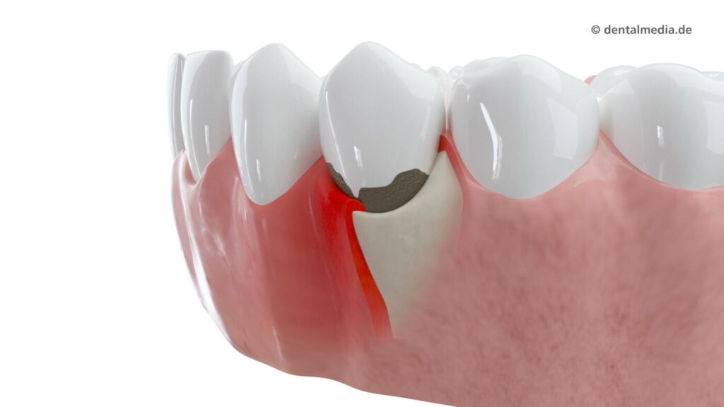 Parodontitis — DENTOPLUS | Ihre Praxis für Zahnheilkunde in Moers