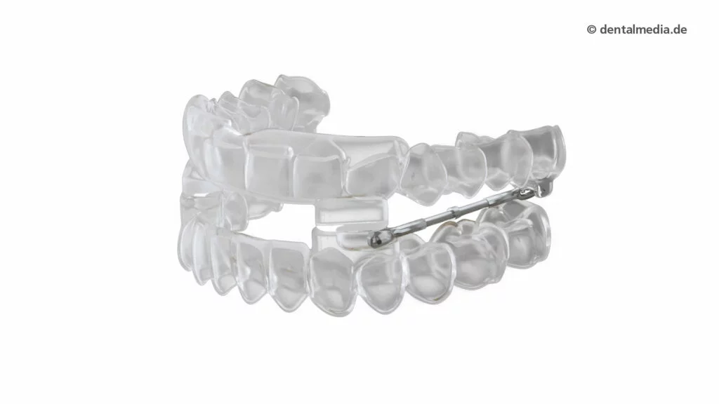Schnarcherschiene — DENTOPLUS | Ihre Praxis für Zahnheilkunde in Moers